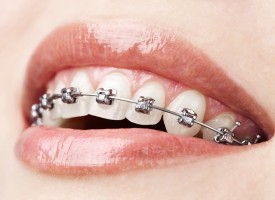 Orthodontie : choix des appareils