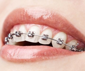 Orthodontie : choix des appareils
