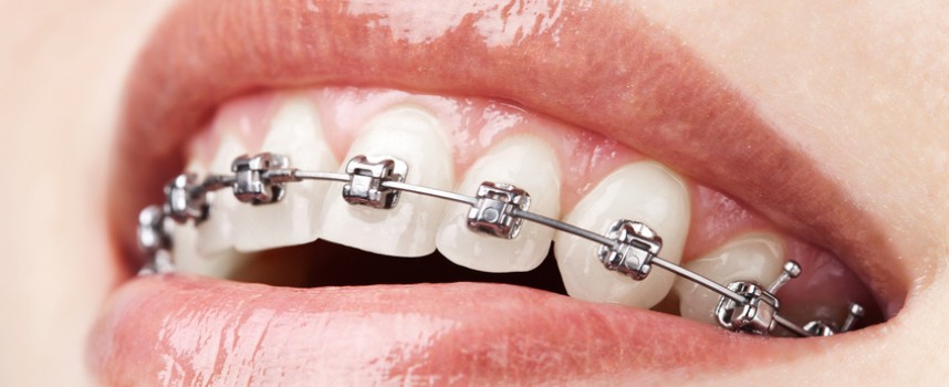 Orthodontie : choix des appareils