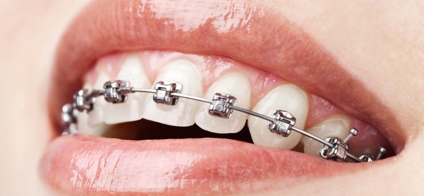 Orthodontie : choix des appareils