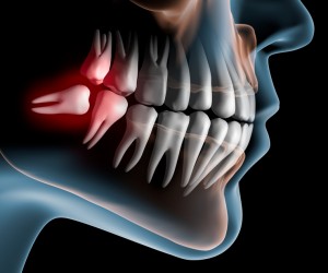 Orthodontie et extractions dentaires