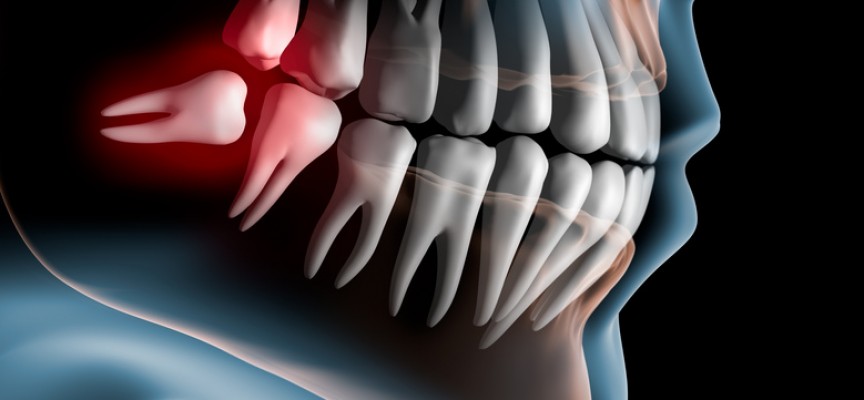 Orthodontie et extractions dentaires