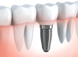 Qu’est-ce qu’un implant dentaire ?