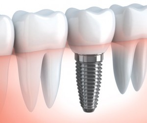 Qu’est-ce qu’un implant dentaire ?