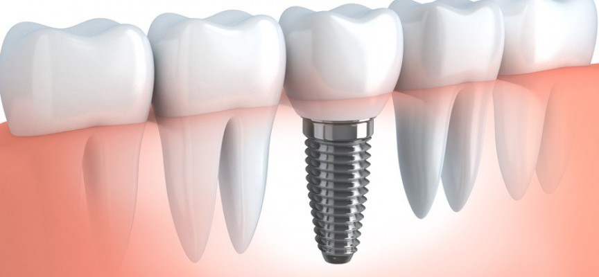 Qu’est-ce qu’un implant dentaire ?