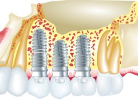 Indications des implants dentaires