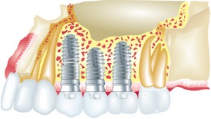 Implants dentaires