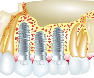 Indications des implants dentaires