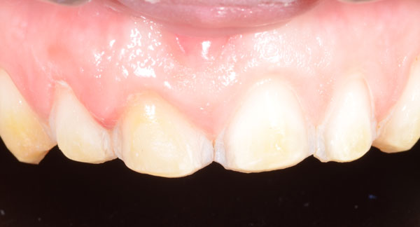 Fig. 10 : l’émail des dents à recouvrir est préparé à minima à l’aide de fraises diamantées