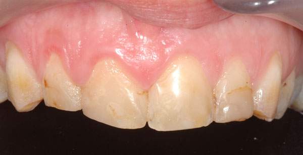 Fig. 3 : malformations généralisées de l’émail