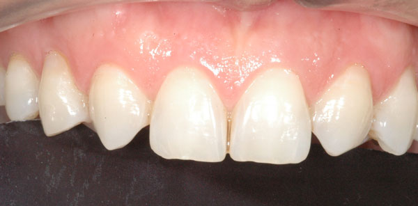 Fig. 4 : dents trop pointues (canines mises orthodontiquement en position d’incisives latérales)