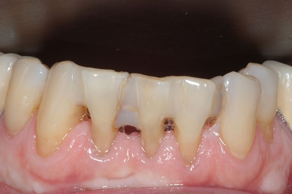 Fig. 6 : espaces noirs disgracieux entre les dents