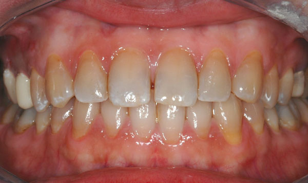réalignement-orthodontique