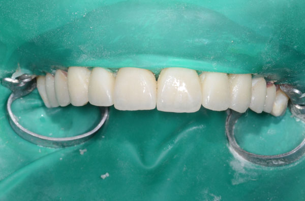 les dents sont isolées sous une feuille de latex (digue) et les facettes en céramique sont collées