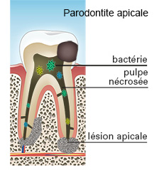 parodontite-apicale