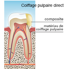 coiffage pulpaire direct