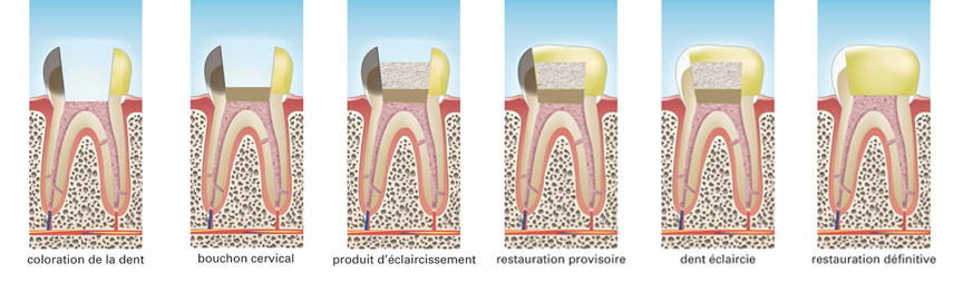 Eclaircissement de la dent dépulpée