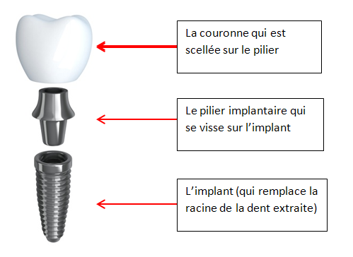 restauration implantaire unitaire