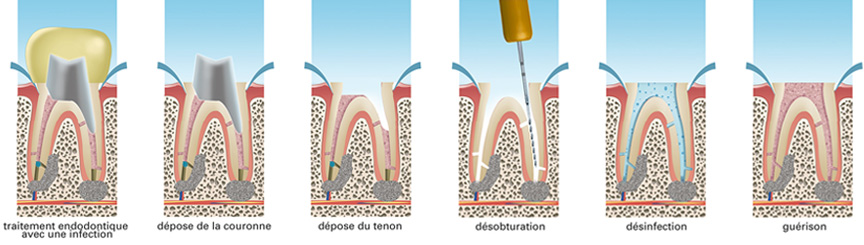 retraitement-endodontique