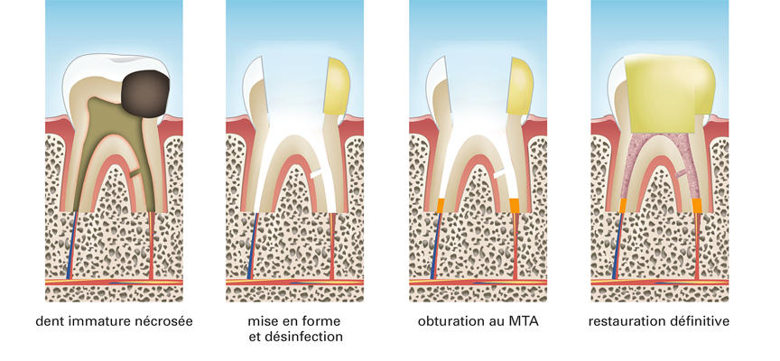 apexification