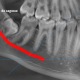 Perte de sensibilité suite à une extraction de dents de sagesse