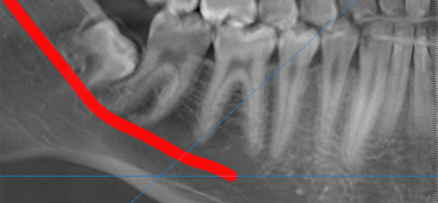 Perte de sensibilité suite à une extraction de dents de sagesse