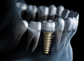 Je dois prochainement me faire poser un implant sur une des dents de devant. Cela va-t-il se voir ? Est-ce un traitement esthétique ?