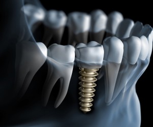 Je dois prochainement me faire poser un implant sur une des dents de devant. Cela va-t-il se voir ? Est-ce un traitement esthétique ?