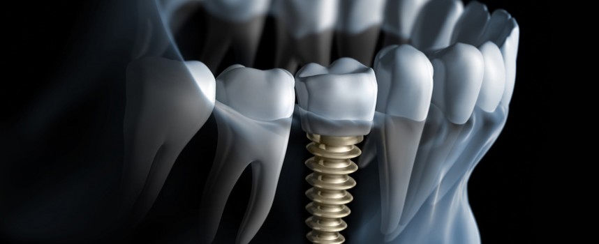 Je dois prochainement me faire poser un implant sur une des dents de devant. Cela va-t-il se voir ? Est-ce un traitement esthétique ?