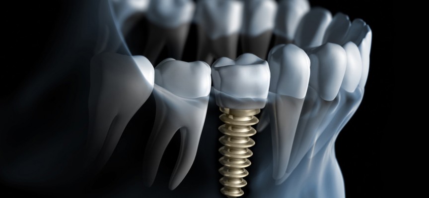 Je dois prochainement me faire poser un implant sur une des dents de devant. Cela va-t-il se voir ? Est-ce un traitement esthétique ?