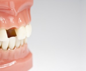 Reste-t’on sans dents pendant la cicatrisation de l’implant ?